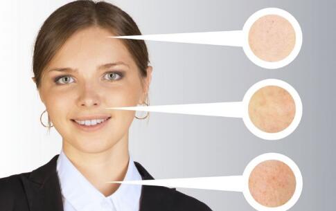 去除痘痘的方法 去痘的小竅門 如何祛除痘痘