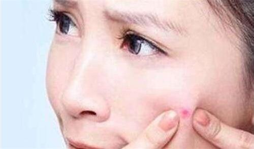 長痘痘不必驚慌，豆尚祛痘教你五個小妙招