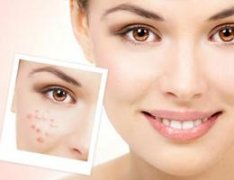 豆尚教你青春痘疤痕修復方法