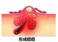 為什么痘痘會發(fā)炎，發(fā)炎要怎么處理？豆尚來幫您