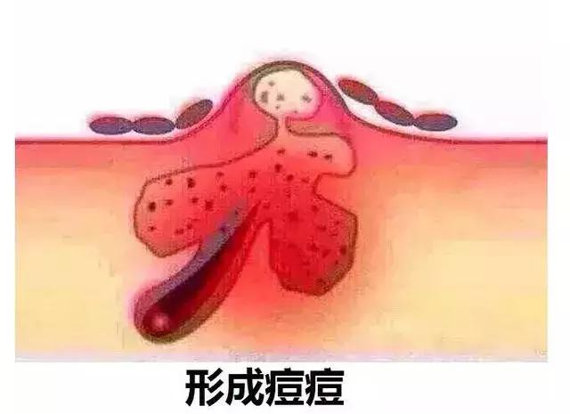 為什么痘痘會發(fā)炎，發(fā)炎要怎么處理？