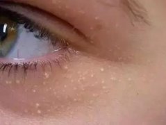 豆尚 | 眼部“難題”脂肪粒 如何處理見(jiàn)效快？