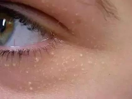 眼部“難題”脂肪粒 如何處理見效快？