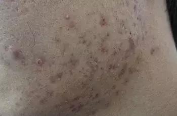 痘坑、痘印會自愈嗎？豆尚導(dǎo)師為你解答