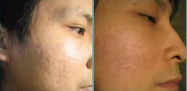 一坑毀所有，我要填平痘坑去往新生