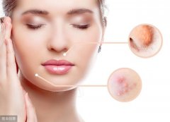 青春痘反反復(fù)復(fù)，豆尚帶你來(lái)了解一下8大祛痘誤區(qū)