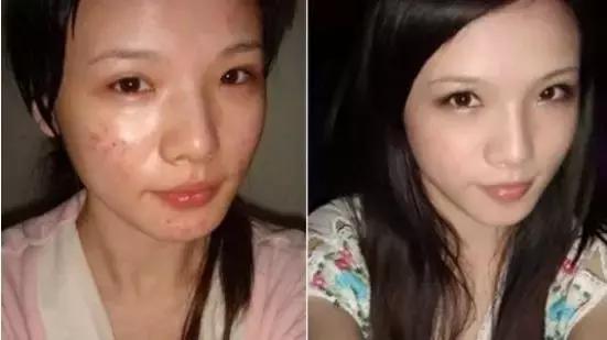 痤瘡可以根治？別再受騙了！豆尚專業(yè)祛痘來告訴你原因