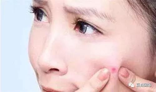 長(zhǎng)痘痘不必驚慌，豆尚祛痘教你六個(gè)祛痘小妙招