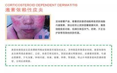 豆尚八大服務(wù)_5.激素依賴性皮炎