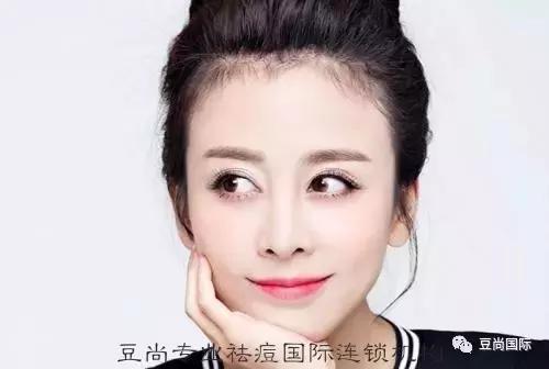 痘印沒了，肌膚變白了，說說這是為啥？