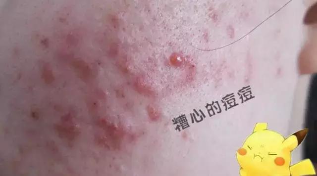 治痘好多年，方法用盡為什么還是不好？