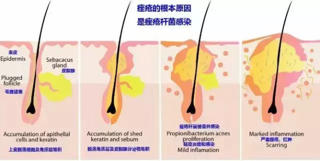 治痘好多年，方法用盡為什么還是不好？