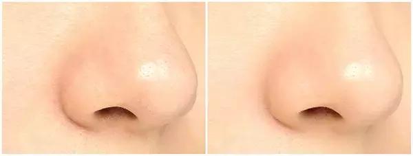 祛黑頭的10個問題答案，原來你是這樣的黑頭