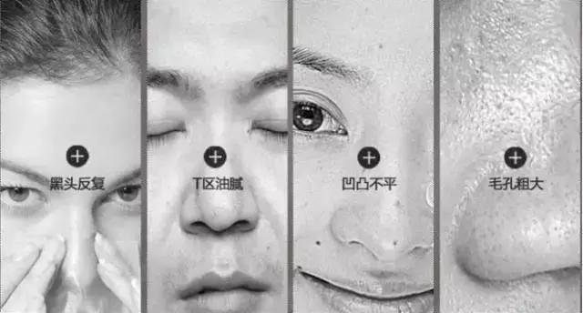 祛黑頭的10個問題答案，原來你是這樣的黑頭