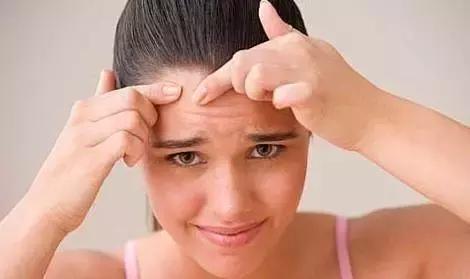 痘痘擠擠不健康，小心讓你留下瘢