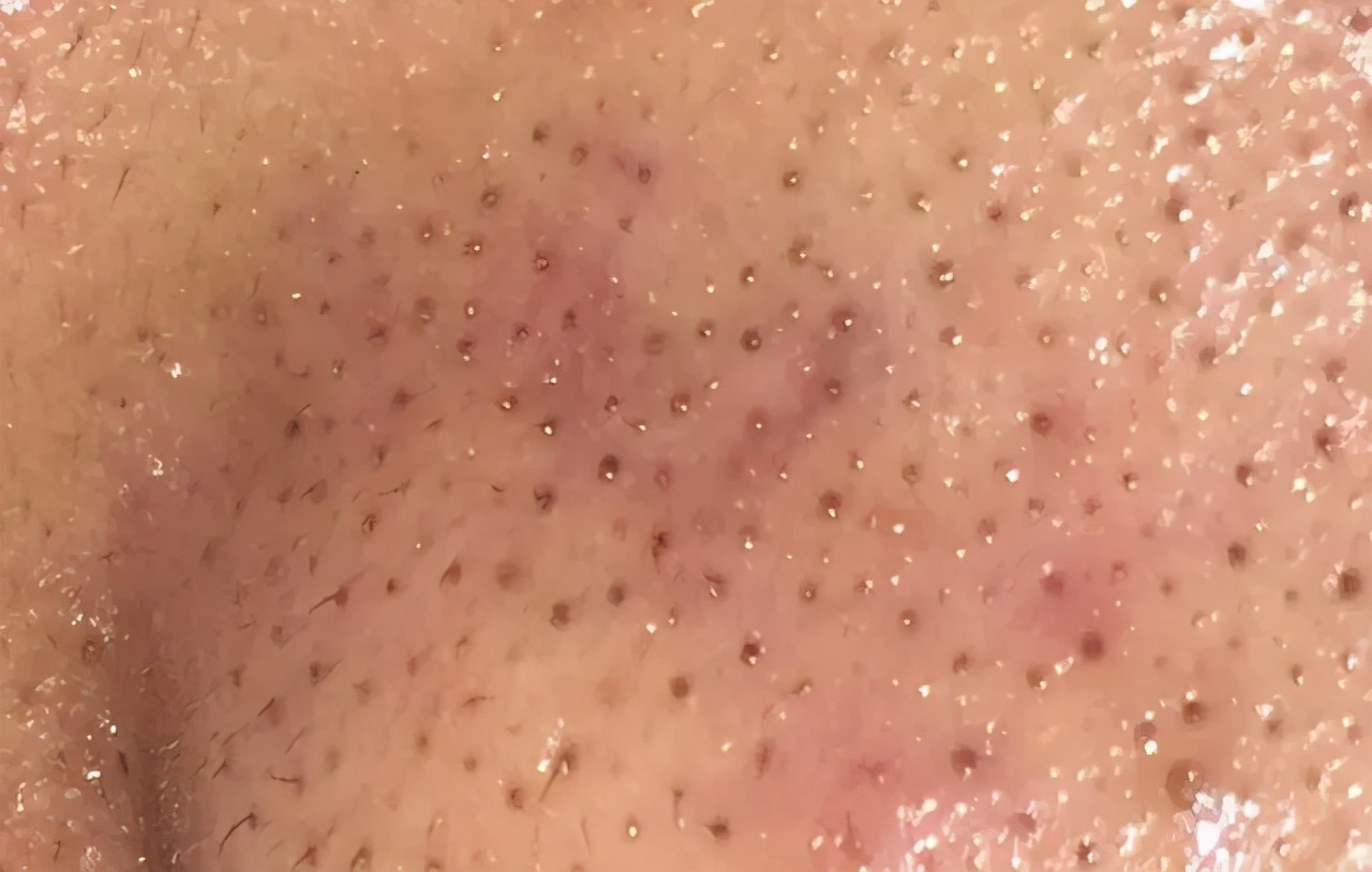 來看看你是什么類型的黑頭