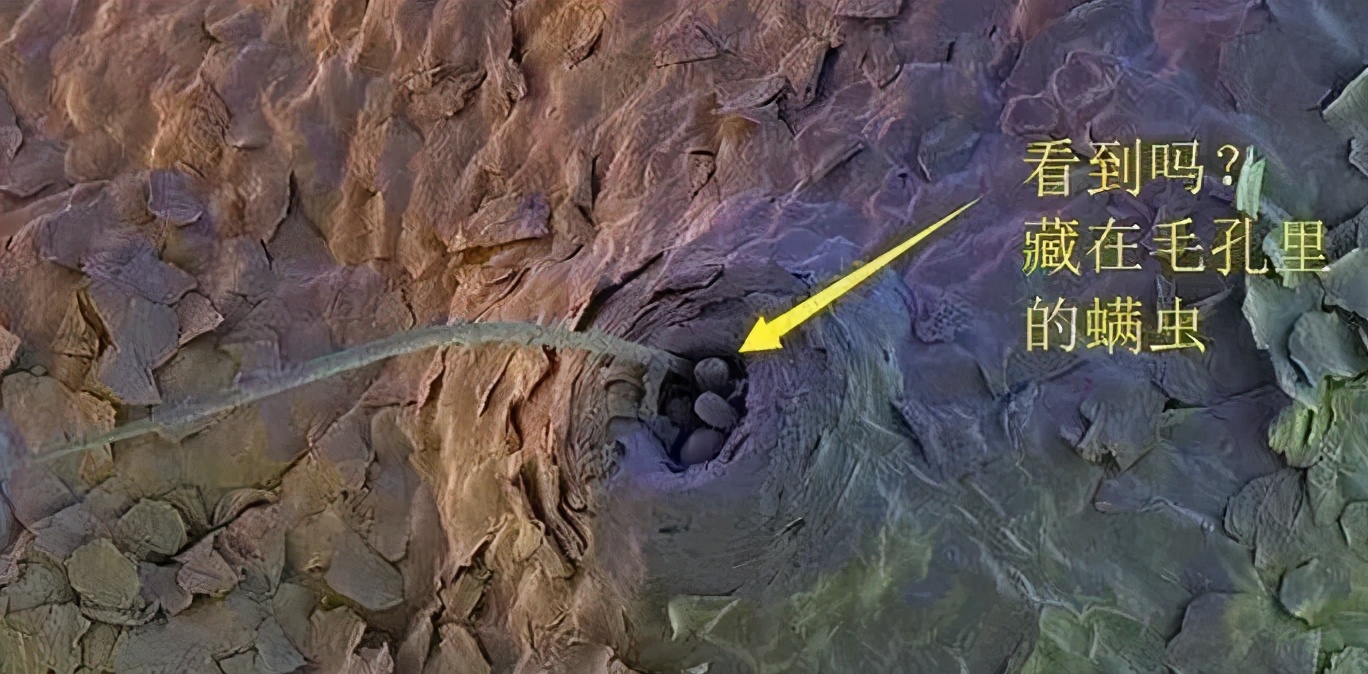 來看看你是什么類型的黑頭