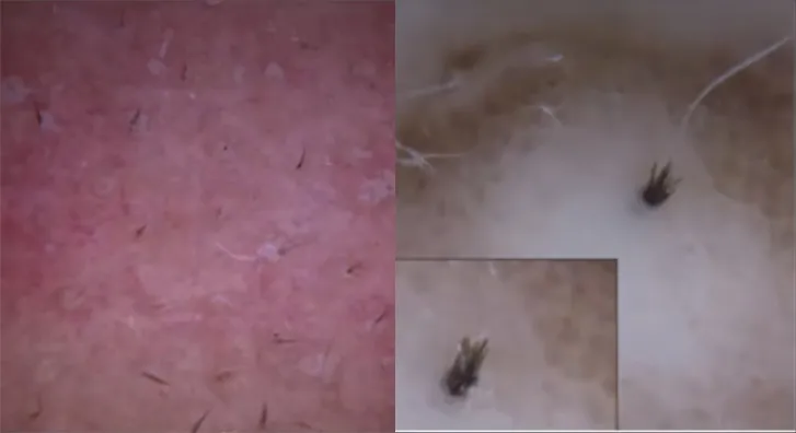 來看看你是什么類型的黑頭