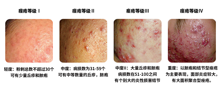 豆尚：刷酸=祛痘？祛痘其實(shí)可以不用依賴刷酸